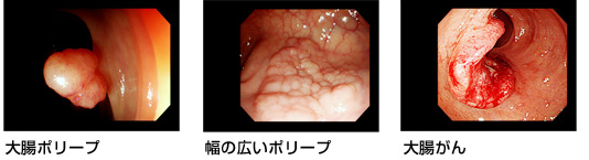 大腸ポリープとがん