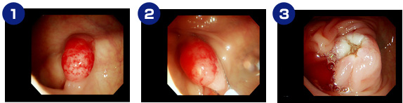 ポリープ切除