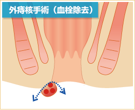 外痔核