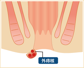 外痔核