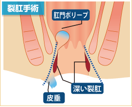 裂肛　切れ痔