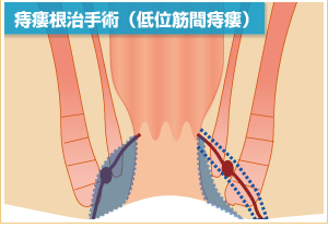 肛門周囲膿瘍と痔瘻