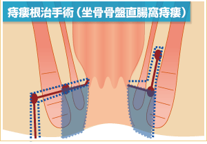 肛門周囲膿瘍と痔瘻