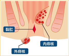 痔にはさまざまな種類があります。